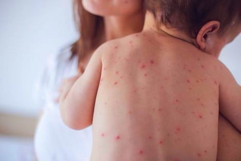 داء الحصبة “بوحمرون” يجتاح دواوير بإقليم شيشاوة