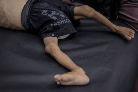 “غيلان باريه”.. مرض خطير يهاجم أطفال غزة ويتسبب في وفيات